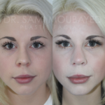 Source: Dr. Moubayed’s practice. Not a guarantee of results. Photos published with informed written consent of patients Female treated with rhinoplasty and alar base reductions