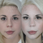 Source: Dr. Moubayed’s practice. Not a guarantee of results. Photos published with informed written consent of patients Female treated with rhinoplasty and alar base reductions