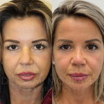 Source: Dr. Moubayed’s practice. Not a guarantee of results. Photos published with informed written consent of patients Female treated with ultrasonic rhinoplasty