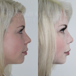 Source: Dr. Moubayed’s practice. Not a guarantee of results. Photos published with informed written consent of patients Female treated with rhinoplasty and alar base reductions