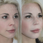 Source: Dr. Moubayed’s practice. Not a guarantee of results. Photos published with informed written consent of patients Female treated with rhinoplasty and alar base reductions
