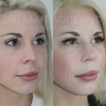 Source: Dr. Moubayed’s practice. Not a guarantee of results. Photos published with informed written consent of patients Female treated with rhinoplasty and alar base reductions