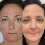 Source: Dr. Moubayed’s practice. Not a guarantee of results. Photos published with informed written consent of patients Female treated with ultrasonic rhinoplasty