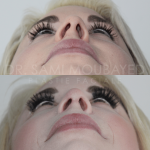Source: Dr. Moubayed’s practice. Not a guarantee of results. Photos published with informed written consent of patients Female treated with rhinoplasty and alar base reductions