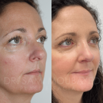 Source: Dr. Moubayed’s practice. Not a guarantee of results. Photos published with informed written consent of patients Female treated with ultrasonic rhinoplasty