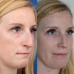 Source: Dr. Moubayed’s practice. Not a guarantee of results. Photos published with informed written consent of patients Female treated with ultrasonic rhinoplasty