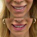 Already such a lip lift beautiful result after only 3 months