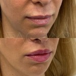Already such a lip lift beautiful result after only 3 months