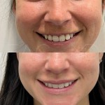Surgical lip lift still in it's healing process after 3 months only!