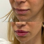 Already such a lip lift beautiful result after only 3 months