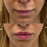 Already such a lip lift beautiful result after only 3 months