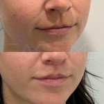 Surgical lip lift still in it's healing process after 3 months only!