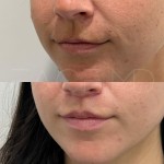 Surgical lip lift still in it's healing process after 3 months only!