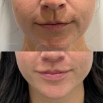 Surgical lip lift still in it's healing process after 3 months only!