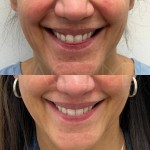 Result of lip lift after 3 months, still healing but already very satisfying!