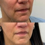 Result of lip lift after 3 months, still healing but already very satisfying!