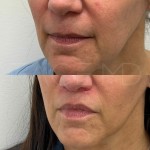 Result of lip lift after 3 months, still healing but already very satisfying!