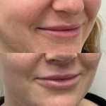3 months after lip lift, scar healing beautifully and will become almost invisible after full healing