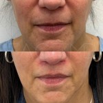 Result of lip lift after 3 months, still healing but already very satisfying!