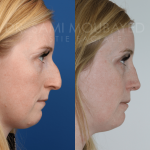 Source: Dr. Moubayed’s practice. Not a guarantee of results. Photos published with informed written consent of patients Female treated with ultrasonic rhinoplasty
