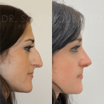 Source: Dr. Moubayed’s practice. Not a guarantee of results. Photos published with informed written consent of patients Female treated with ultrasonic rhinoplasty