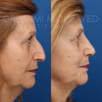 Source: Dr. Moubayed’s practice. Not a guarantee of results. Photos published with informed written consent of patients Female treated with rhinoplasty and alar base reductions