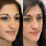 Source: Dr. Moubayed’s practice. Not a guarantee of results. Photos published with informed written consent of patients Female treated with ultrasonic rhinoplasty