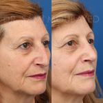 Source: Dr. Moubayed’s practice. Not a guarantee of results. Photos published with informed written consent of patients Female treated with rhinoplasty and alar base reductions