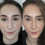 Source: Dr. Moubayed’s practice. Not a guarantee of results. Photos published with informed written consent of patients Middle Eastern female treated with rhinoplasty