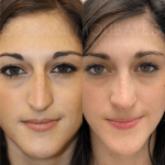 Source: Dr. Moubayed’s practice. Not a guarantee of results. Photos published with informed written consent of patients Female treated with ultrasonic rhinoplasty