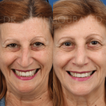Source: Dr. Moubayed’s practice. Not a guarantee of results. Photos published with informed written consent of patients