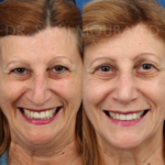 Source: Dr. Moubayed’s practice. Not a guarantee of results. Photos published with informed written consent of patients
