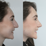 Source: Dr. Moubayed’s practice. Not a guarantee of results. Photos published with informed written consent of patients Middle Eastern female treated with rhinoplasty