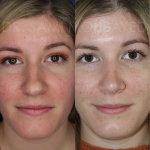 Source: Dr. Moubayed’s practice. Not a guarantee of results. Photos published with informed written consent of patients Female treated with ultrasonic rhinoplasty