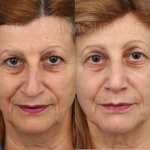 Source: Dr. Moubayed’s practice. Not a guarantee of results. Photos published with informed written consent of patients Female treated with rhinoplasty and alar base reductions