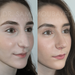 Source: Dr. Moubayed’s practice. Not a guarantee of results. Photos published with informed written consent of patients