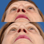 Source: Dr. Moubayed’s practice. Not a guarantee of results. Photos published with informed written consent of patients Female treated with rhinoplasty and alar base reductions
