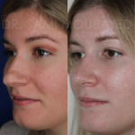 Source: Dr. Moubayed’s practice. Not a guarantee of results. Photos published with informed written consent of patients Female treated with ultrasonic rhinoplasty
