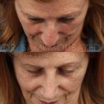 Source: Dr. Moubayed’s practice. Not a guarantee of results. Photos published with informed written consent of patients Female treated with rhinoplasty and alar base reductions