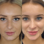 Source: Dr. Moubayed’s practice. Not a guarantee of results. Photos published with informed written consent of patients Female treated with ultrasonic rhinoplasty
