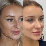 Source: Dr. Moubayed’s practice. Not a guarantee of results. Photos published with informed written consent of patients Female treated with ultrasonic rhinoplasty
