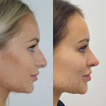 Source: Dr. Moubayed’s practice. Not a guarantee of results. Photos published with informed written consent of patients Female treated with ultrasonic rhinoplasty