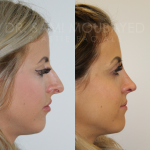 Source: Dr. Moubayed’s practice. Not a guarantee of results. Photos published with informed written consent of patients Female treated with ultrasonic rhinoplasty