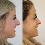 Source: Dr. Moubayed’s practice. Not a guarantee of results. Photos published with informed written consent of patients Female treated with ultrasonic rhinoplasty