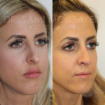 Source: Dr. Moubayed’s practice. Not a guarantee of results. Photos published with informed written consent of patients Female treated with ultrasonic rhinoplasty
