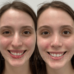 Source: Dr. Moubayed’s practice. Not a guarantee of results. Photos published with informed written consent of patients Female treated with ultrasonic rhinoplasty