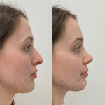 Source: Dr. Moubayed’s practice. Not a guarantee of results. Photos published with informed written consent of patients Female treated with ultrasonic rhinoplasty