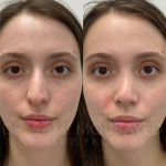Source: Dr. Moubayed’s practice. Not a guarantee of results. Photos published with informed written consent of patients Female treated with ultrasonic rhinoplasty