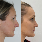 Source: Dr. Moubayed’s practice. Not a guarantee of results. Photos published with informed written consent of patients Female treated with ultrasonic rhinoplasty