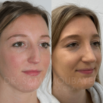 Source: Dr. Moubayed’s practice. Not a guarantee of results. Photos published with informed written consent of patients Female treated with ultrasonic rhinoplasty